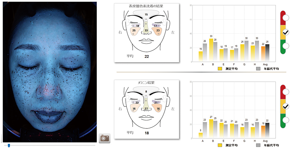 肌診断機で肌を分析します